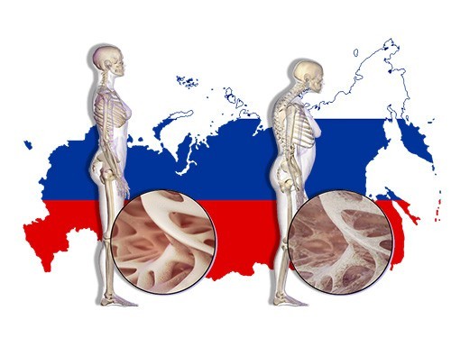 1 перелом в 3 минуты. Последствия остеопороза в России станут тяжелее, если не принять меры